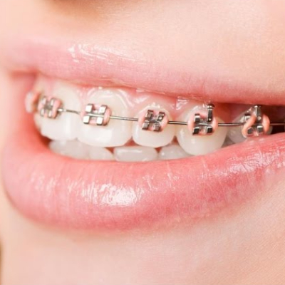 Crooked Teeth: Top Straightening Solutions