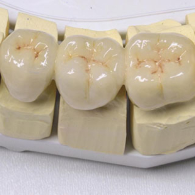 Dental Bridges – Another Option to Restore Your Smile