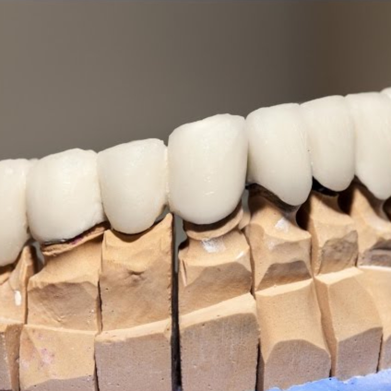 Dental Crown Benefits: A Versatile Restorative Option