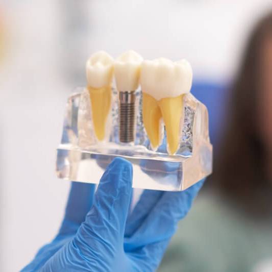 Should You Shop Around for Dental Implants in Adelaide?