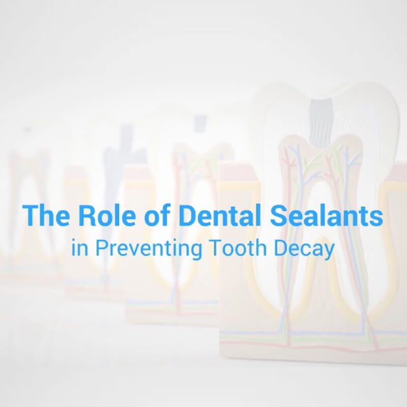 The Role of Dental Sealants in Preventing Tooth Decay