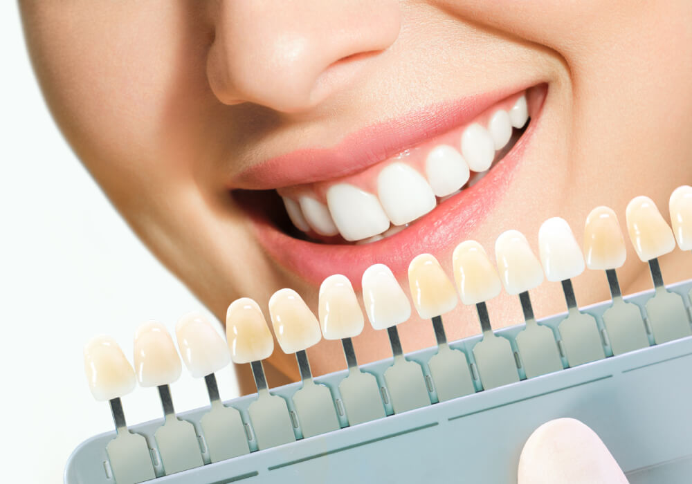Tooth Whitening