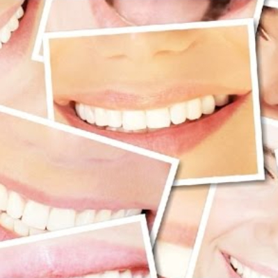 Transform your Smile with Porcelain Veneers