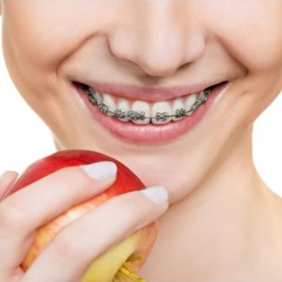 Why there’s a Need to Correct an Overbite?